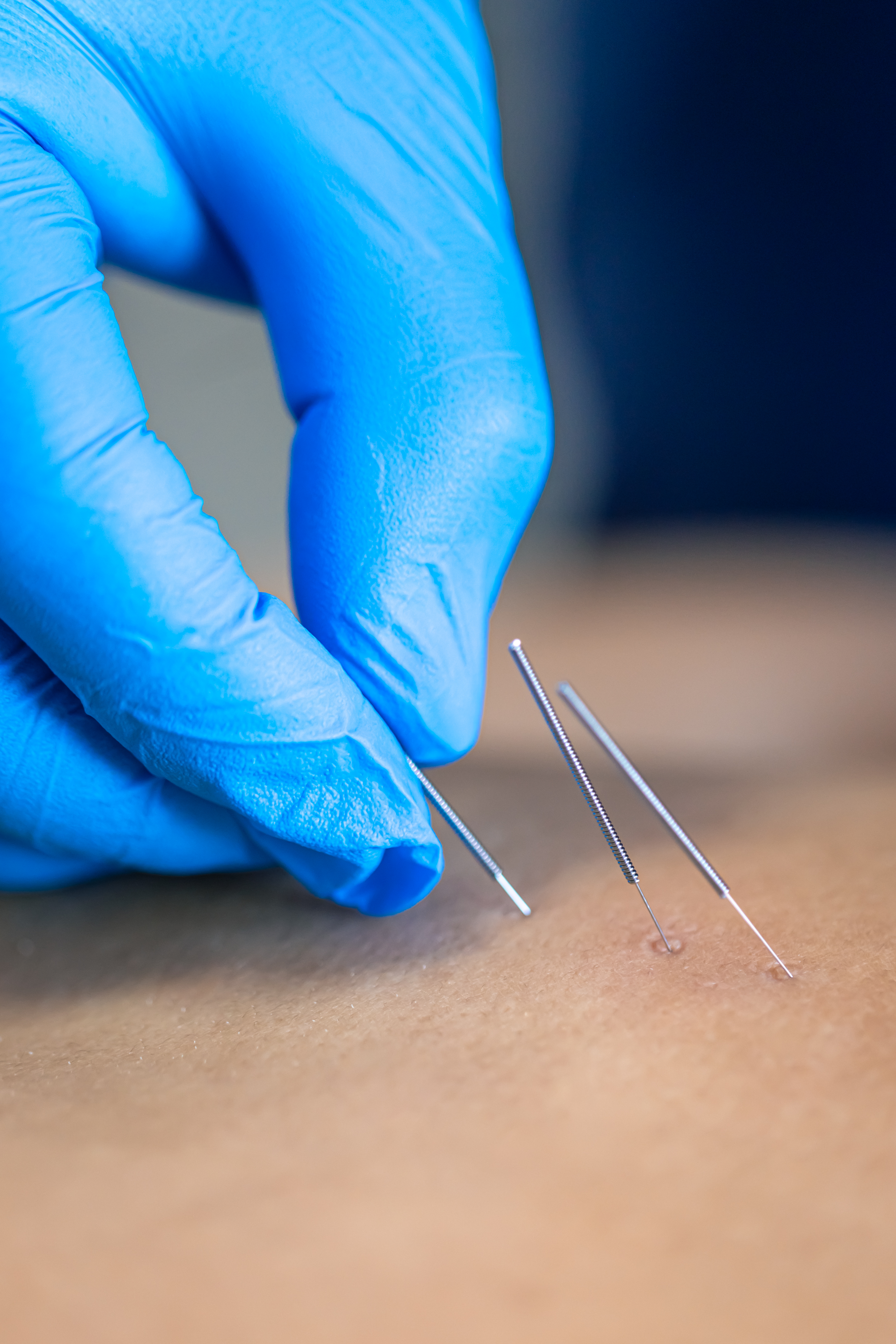 Physiotherapist performing dry needling acupuncture treatment
